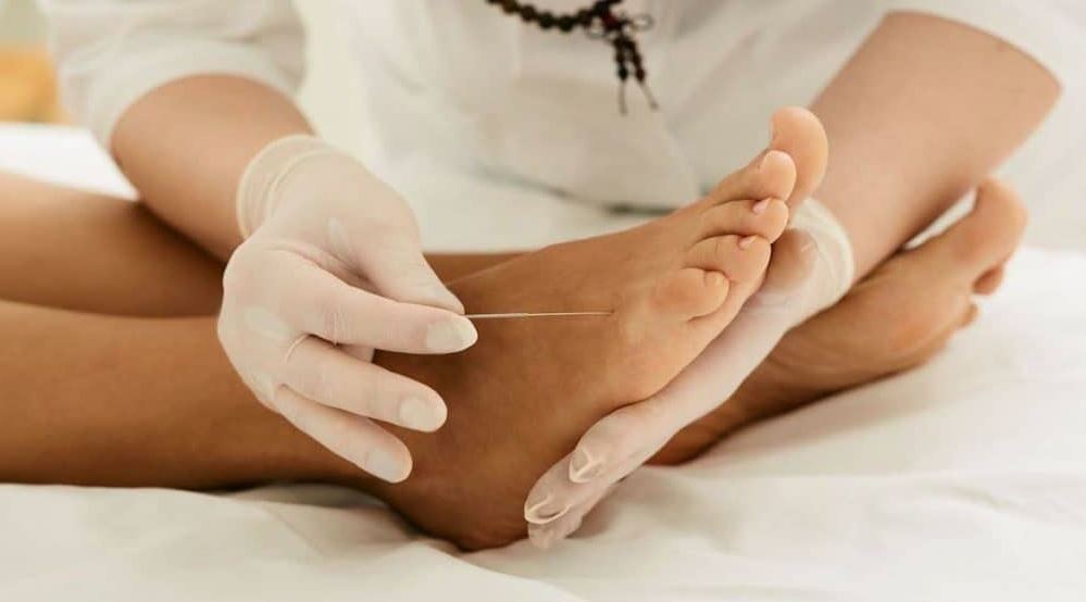Acupuncture for Foot Pain Relief
